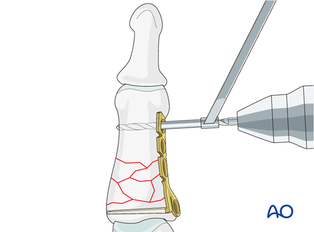 Use a 1.1 mm drill bit to prepare the first neutral screw hole at the distal end of the plate.