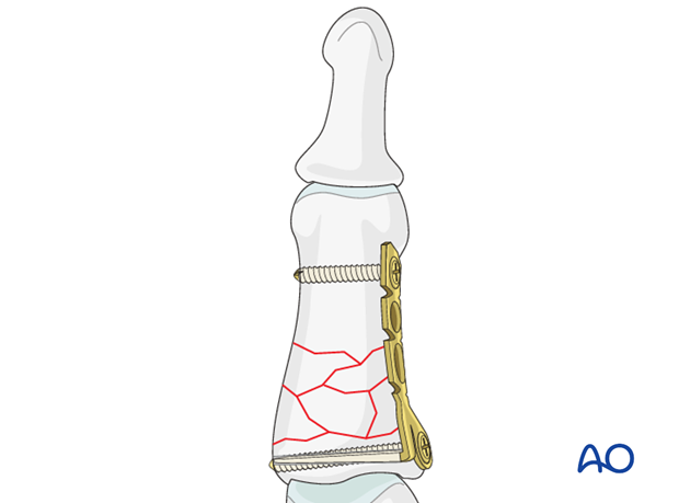 The proximal screw is inserted next, in the same fashion. The screws should just engage the far cortex. This proximal screw ...