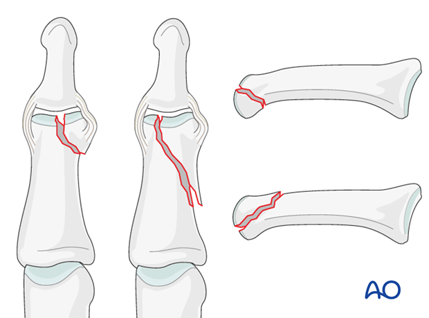 Unicondylar fractures of the middle phalanx can be transverse, short or long oblique, or comminuted.