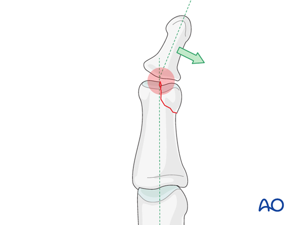 This illustration shows how even slight unicondylar depression may lead to angulation of the finger.