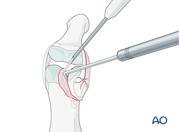 In order to gain a better view of the fracture, use a syringe to irrigate out blood clots with a jet of Ringer lactate. 