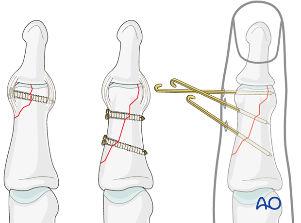 Different types of treatment are available for the various fracture types.