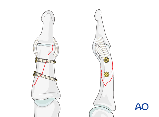 In large fragments, all screws can be placed safely proximal to the collateral ligament of the DIP joint.