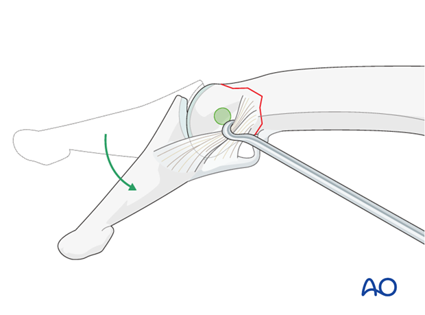 Approach the outer surface of the phalangeal head by flexing the DIP joint.