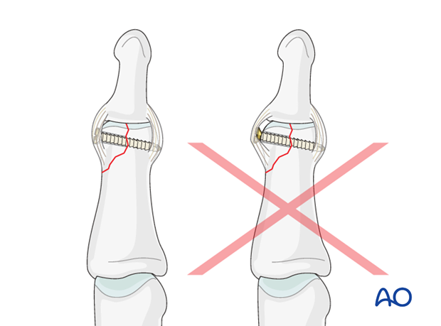 A protruding screw head can cause ligament irritation and eventual joint stiffness.