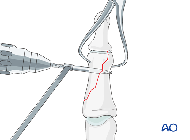 Leaving the reduction forceps in place, drill a gliding hole as perpendicularly to the fracture plane as possible, using a ...