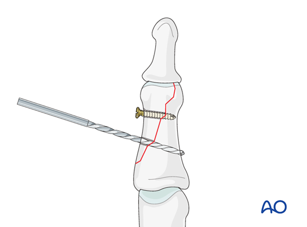 Insert the distal lag screw. Do not completely tighten it at this time. The screw should penetrate the opposite cortex.
