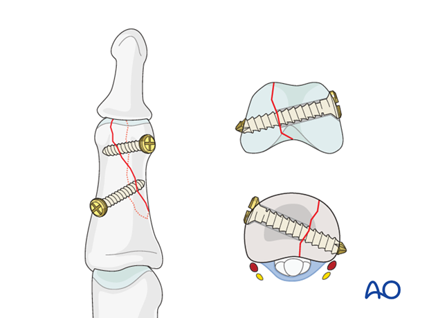 Hastings and Weiss described a fracture type in which the fracture plane changes between the condylar and metaphyseal zones. 