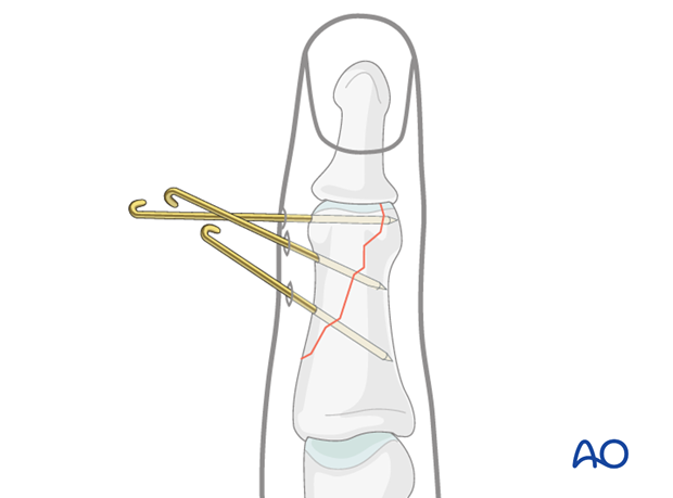 Percutaneous K-wire fixation can be an easy-to-perform and cost-efficient alternative to lag screw fixation. 