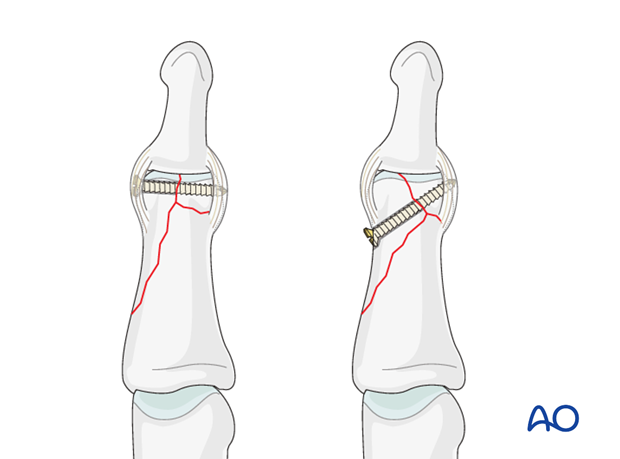 The position of the distal screw depends on the geometry of the fracture line which separates the condyles, and the size ...