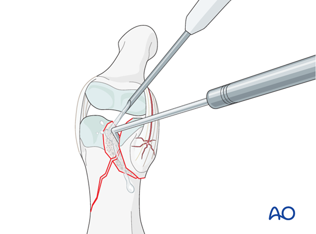 In order to gain a better view of the fracture, use a syringe to irrigate out blood clot with a jet of Ringer lactate.