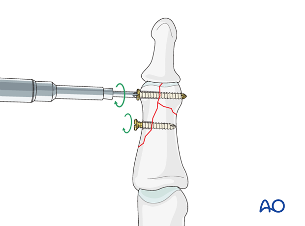 Now insert the diaphyseal lag screw. This screw, too, should just engage the opposite cortex. 