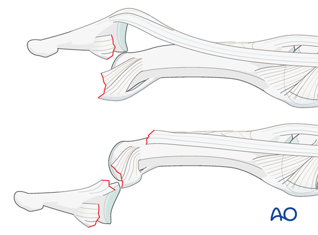 Typically, hyperextension of the finger causes dorsal, or, rarely, palmar dislocation. 