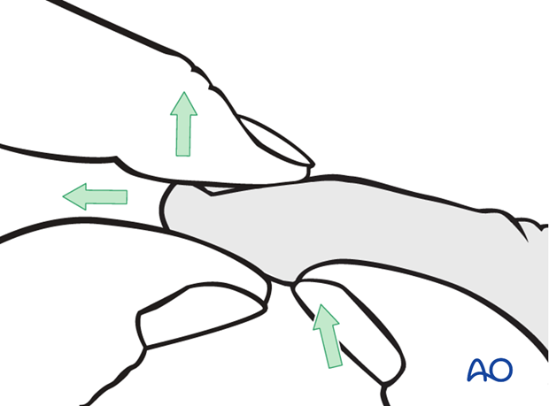 In the case of palmar dislocation, apply traction and extension. Then apply pressure with the thumb on the palmar aspect of ...