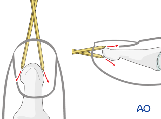 Due to the conical shape of the tip of the distal phalanx, there is a risk of skidding of the K-wire, either in the lateral, ...