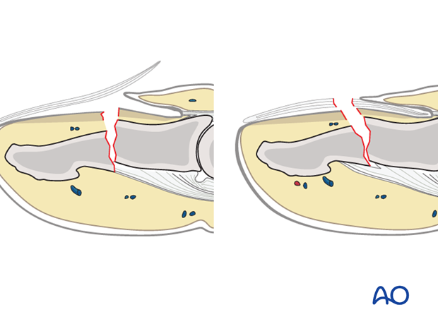 Open fractures present in two ways: with an avulsed nail plate, or with a fractured nail.