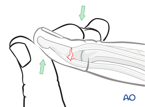 Extend the distal fragment of the fracture by applying pressure with the thumb.