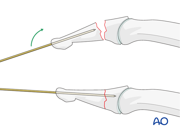 A K-wire can be introduced through the tip of the distal phalanx and advanced not quite up to the fracture line. ...