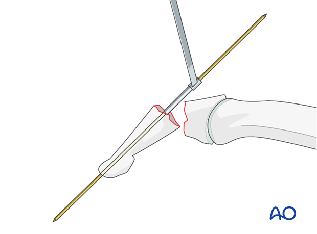 Another option, in open fractures, is to introduce a double-ended K-wire in a retrograde fashion with the inside-out technique.