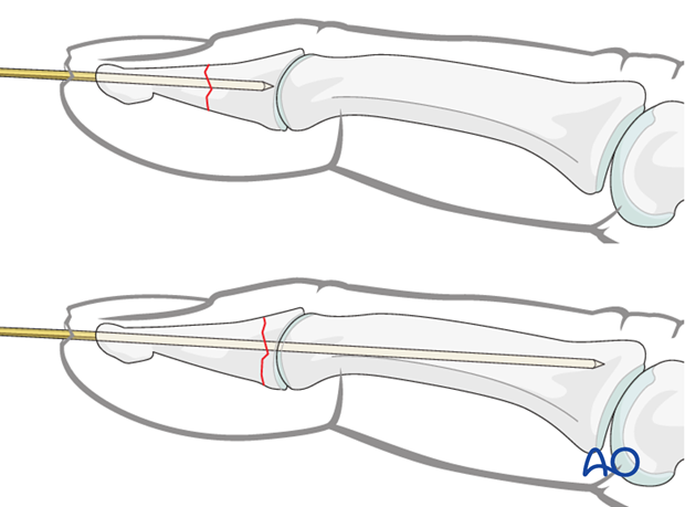 The K-wire is advanced across the distal phalanx up to the DIP joint.