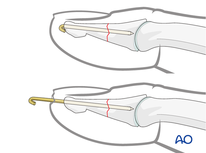 K-wire fixation for Distal phalanx, distal and shaft, transverse