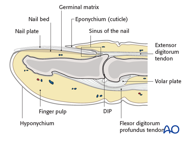 Distal phalanx, base, dorsal avulsion