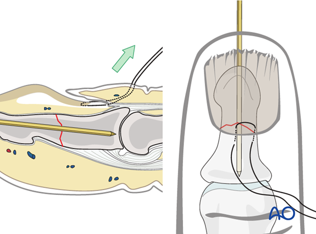 Pass the suture through the free border of the germinal matrix.