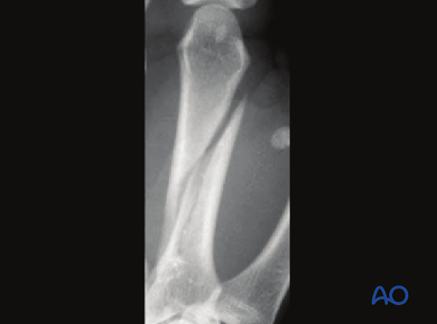 These common fractures are usually best treated with lag screws.