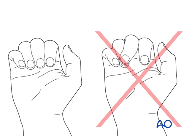 Correct rotation has to be checked with the metacarpophalangeal (MCP) joints flexed to detect any overlapping of the fingers.