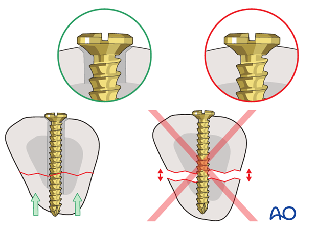 Be sure to insert the screw as a lag screw, with a gliding hole in the near (cis) cortex, and a threaded hole in the ...