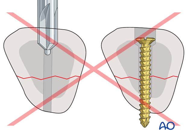 Do not advance the countersink too deeply into the cortex: the cortical thickness will determine the depth of countersinking.