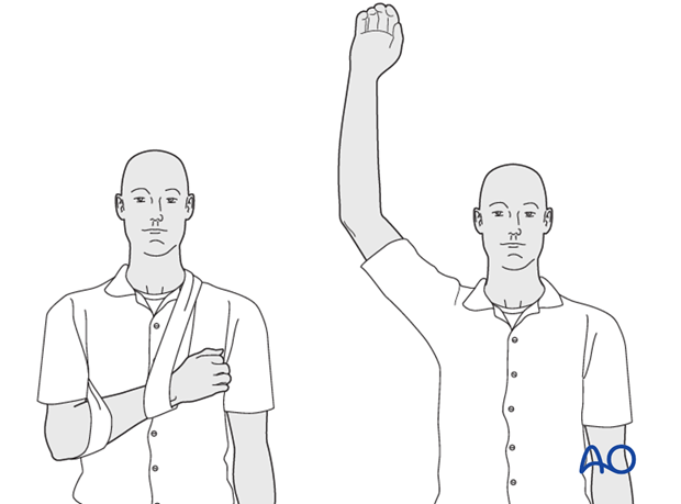 For ambulant patients, put the arm in a sling and elevate to heart level. Instruct the patient to lift his hand regularly above the head, in order to mobilize the shoulder and elbow joints.