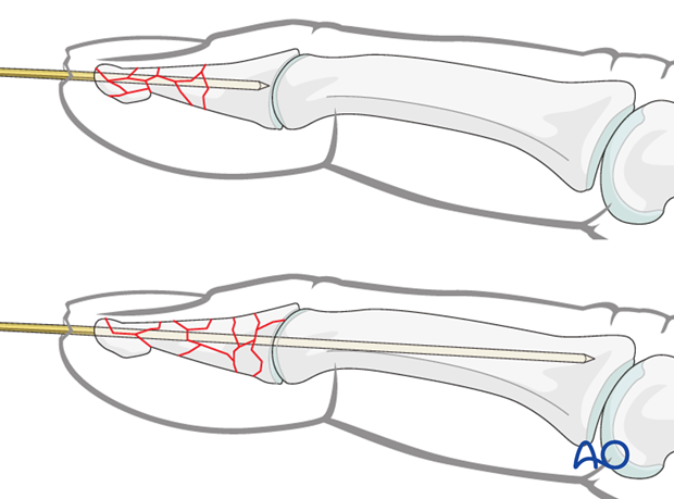 The K-wire is advanced through the distal phalanx up to the DIP joint.