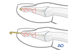 distal phalanx distal and shaft multifragmentary
