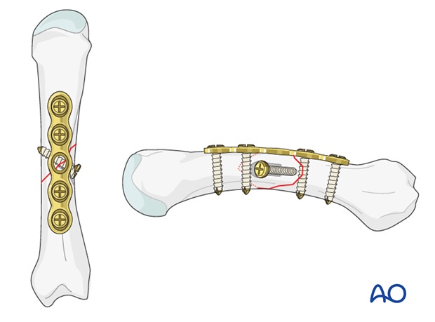 As the screw should be inserted perpendicularly to the fracture plane, in most cases it has to be inserted independently of ...