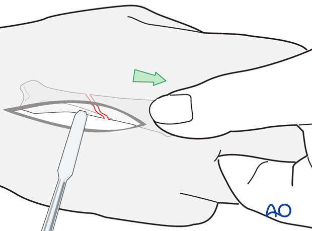 Traction is exerted by an assistant, while the surgeon reduces the fracture, using pressure from a periosteal elevator, or ...
