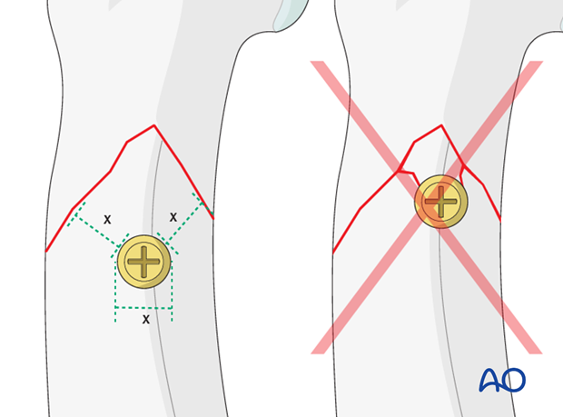 Long oblique head fracture of the proximal phalanx – Lag screw fixation 