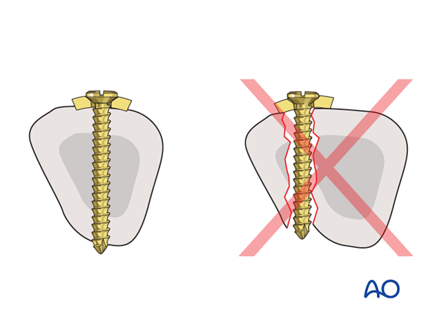 If the plate is not properly centered on the dorsal surface of the metacarpal, the screws may not penetrate the medullary ...
