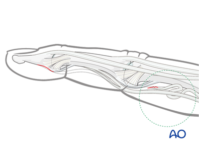 Suture fixation for Proximal, palmar avulsion