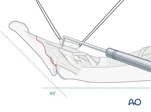 Gently use a dental pick to reduce the fracture accurately.