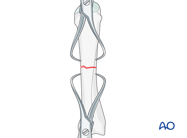 Two pointed reduction forceps can be used for direct reduction. As most of these fractures have a flexion deformity ...
