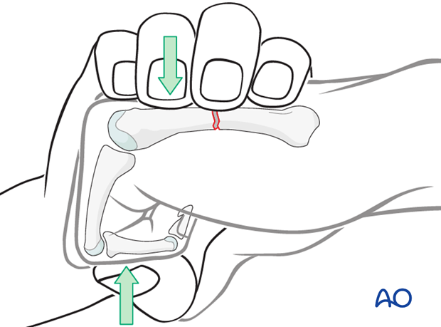 Alternatively, maximally flex the finger at the metacarpophalangeal (MCP) and proximal interphalangeal (PIP) joints and use ...