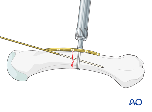 Use a depth gauge to determine screw length.