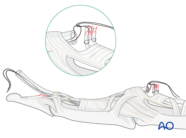 If the tendon has retracted to the PIP joint, the zigzag incision has to be extended to the PIP joint. 