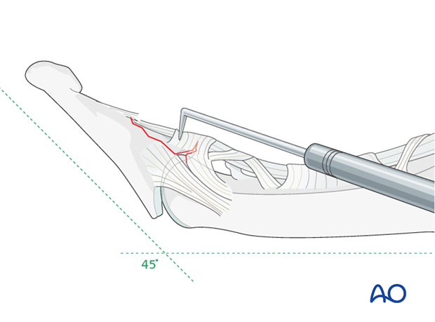 Reduce the small bony fragment with a dental pick and hold it in place.