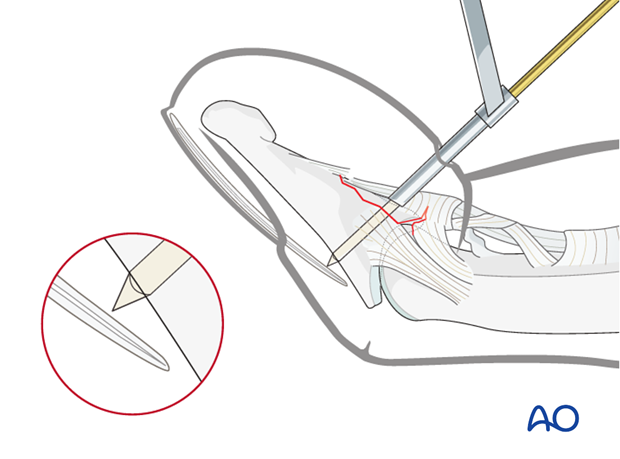 Use a drill guide to insert a 0.035 inch K-wire, engaging the far cortex, but not penetrating the nail bed.