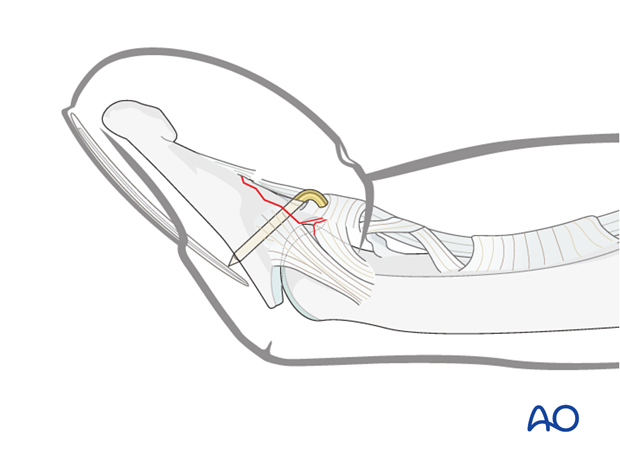 Bend the tip of the K-wire by about 90 degrees, as close to the tendon as possible to avoid soft-tissue irritation.