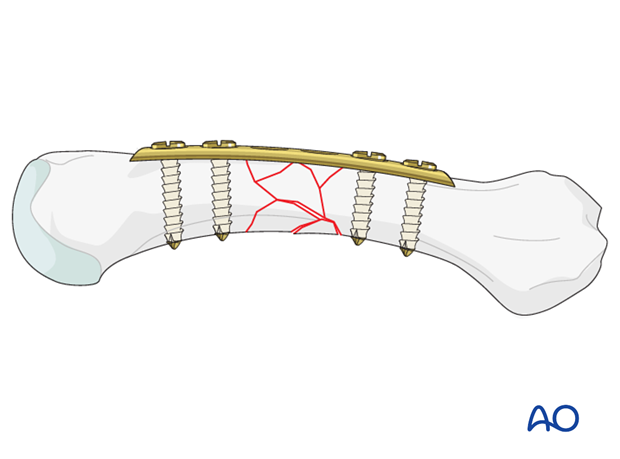 Bridge plating uses the plate as an extramedullary splint fixed to the two main fragments, while the complex fracture zone ...