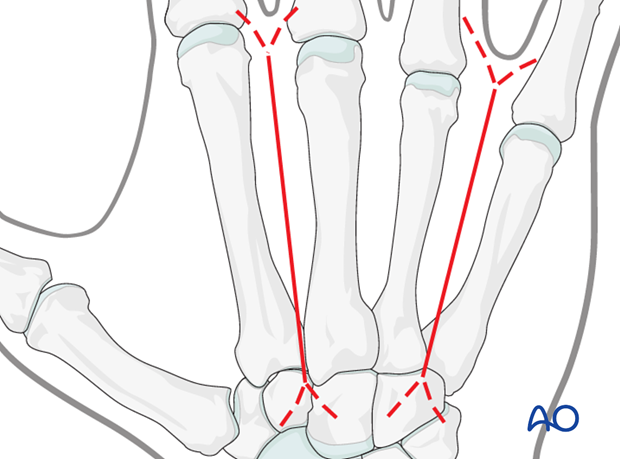 When multiple metacarpals are injured, restoration of length and rotation is difficult. If one of the finger metacarpals is ...