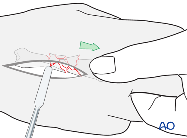 The fracture is reduced by using longitudinal traction on the finger, manually, using a finger trap, or with pointed reduction f